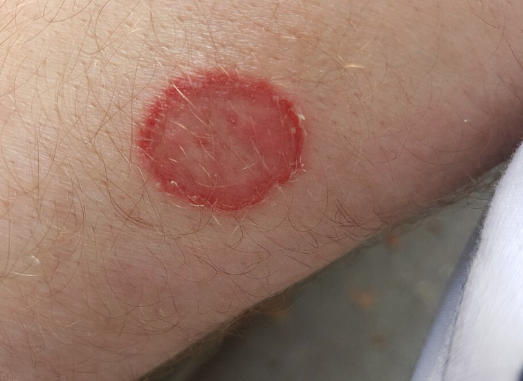 Dermatophytosis auf menschlicher Haut, ringförmige Rötung als typisches Symptom einer Pilzinfektion