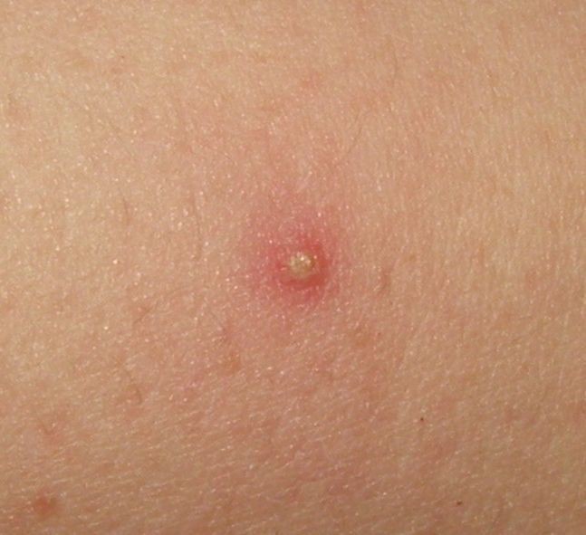 isolated folliculitis auf menschlicher Haut, Nahaufnahme eines einzelnen entzündeten Haarfollikels
