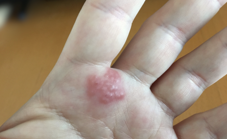 Allergic Contact Dermatitis auf der Handfläche mit geröteter, entzündeter Hautstelle