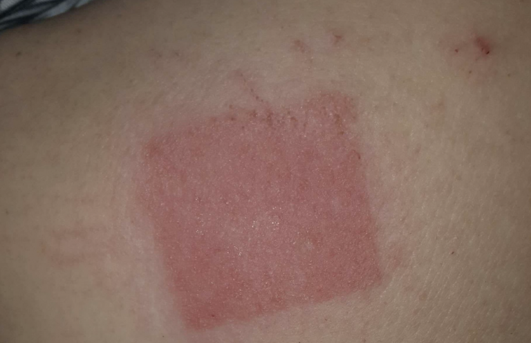 Allergische Reaktion auf der Haut nach Pflasteranwendung, gerötete und gereizte Hautstelle